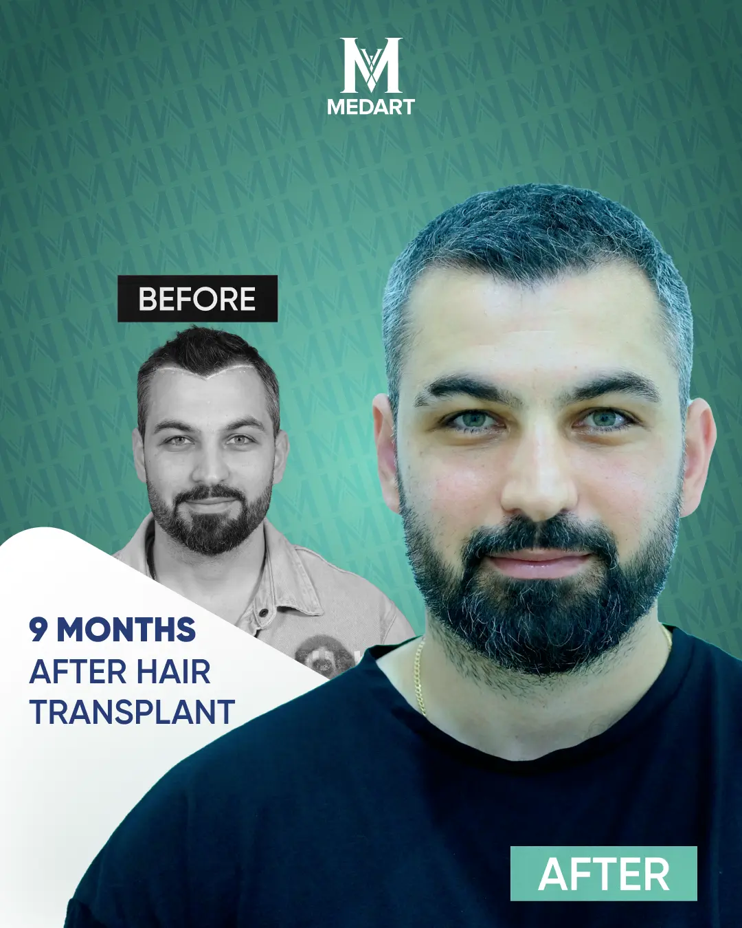 /images/ba2.webp Before After Image