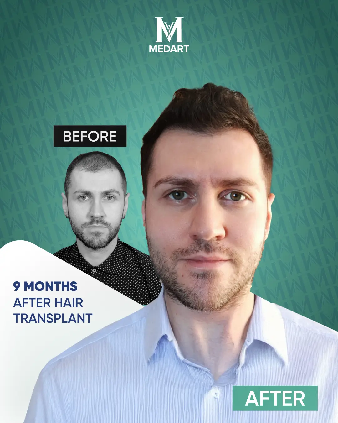/images/ba3.webp Before After Image