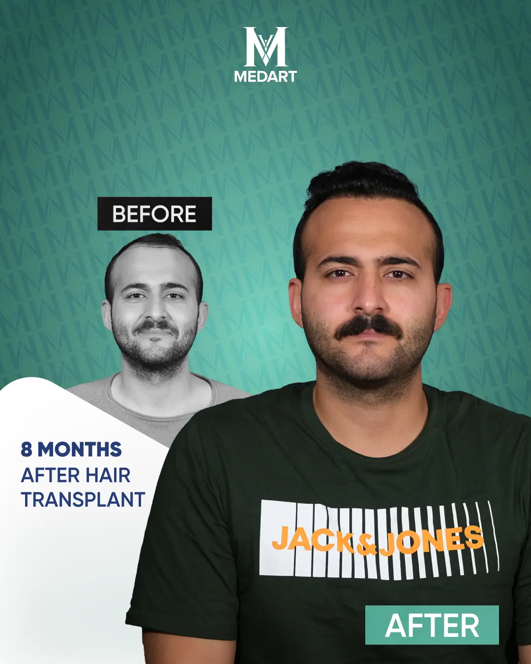 /images/ba4.webp Before After Image