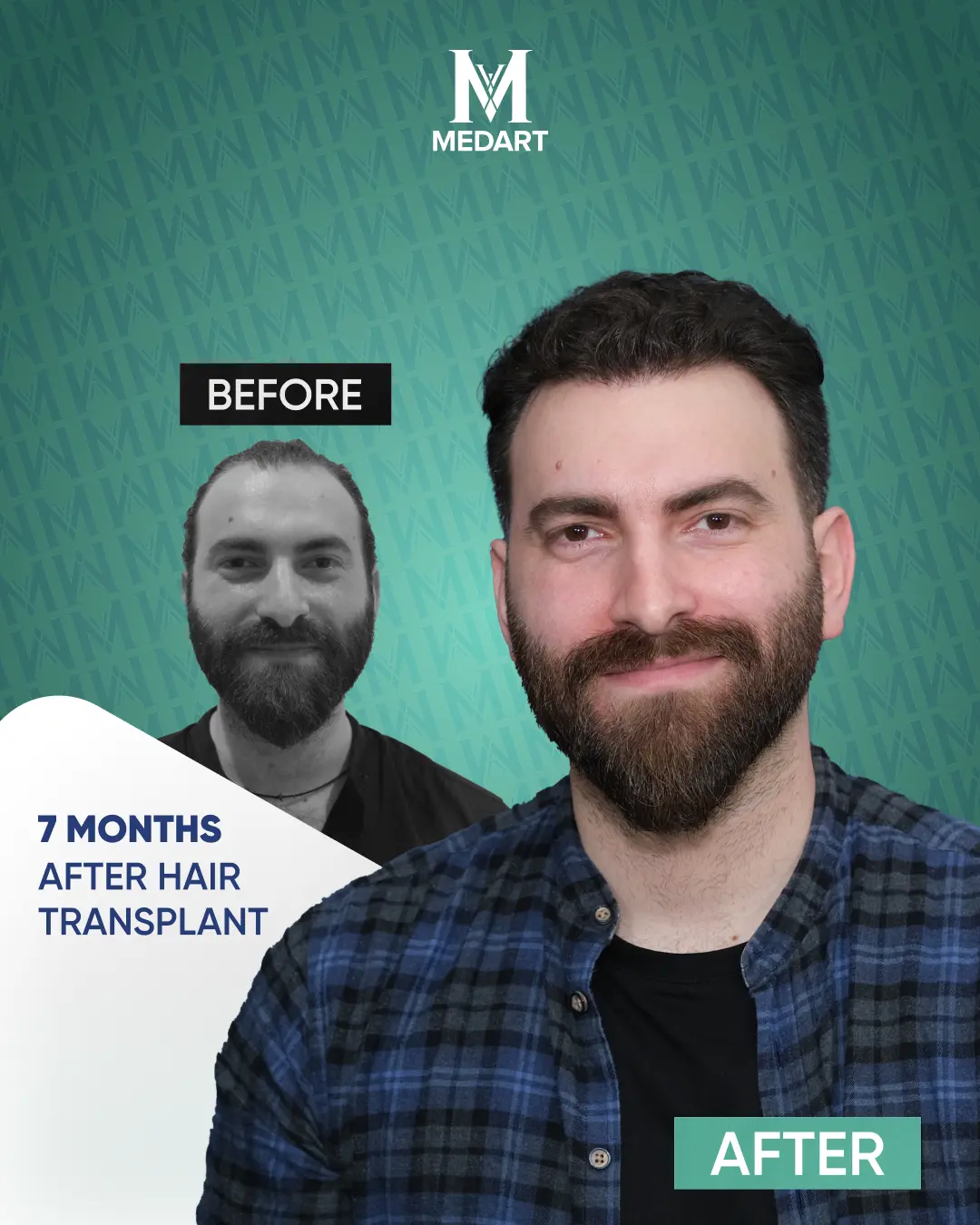 /images/ba5.webp Before After Image