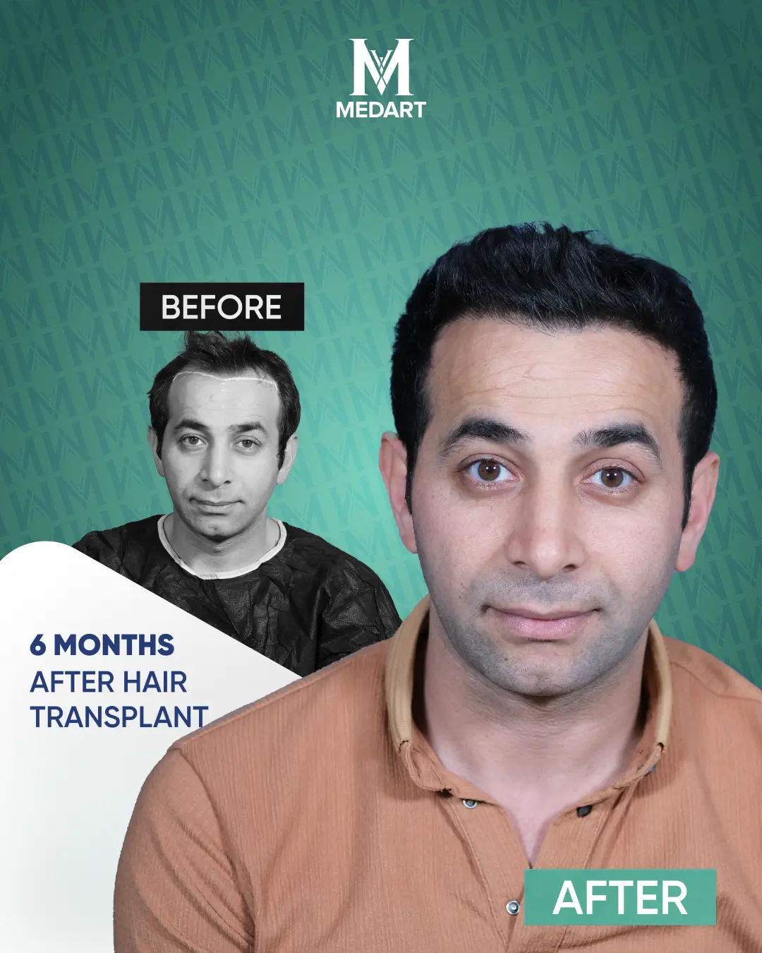 /images/ba7.webp Before After Image
