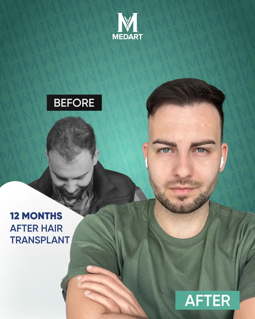 /images/ba8.webp Before After Image